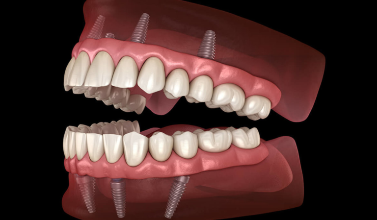 Benefits of taking a service from all on 4 dental implant clinic